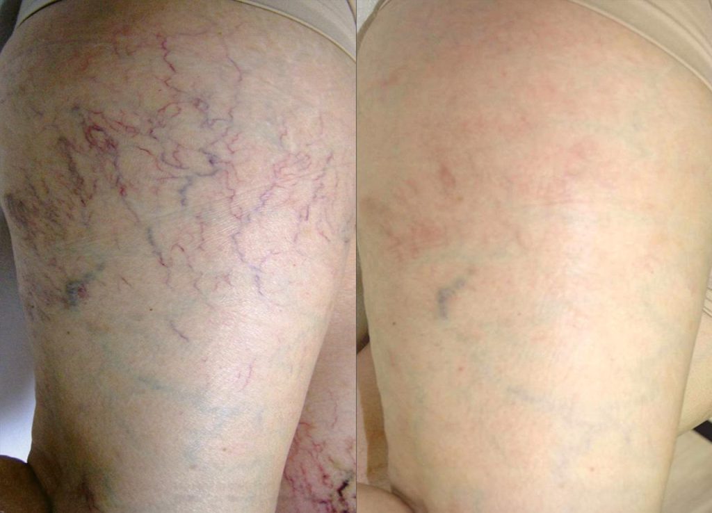 laser-leg-vein-removal-etobicoke