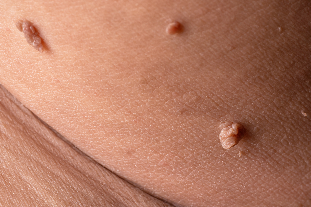 skin tag removal near you